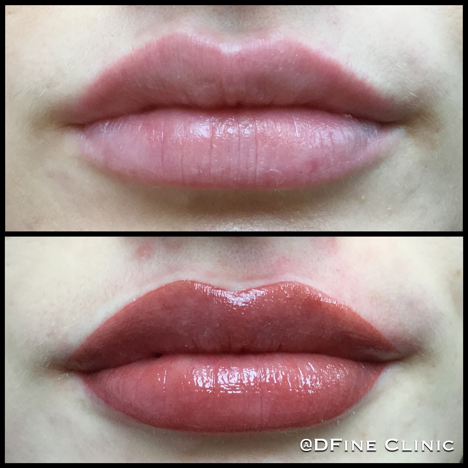 Permanente make-up lippen, resultaat van DFine Clinic (2) Permanente make-up lippen, resultaat van DFine Clinic (2)