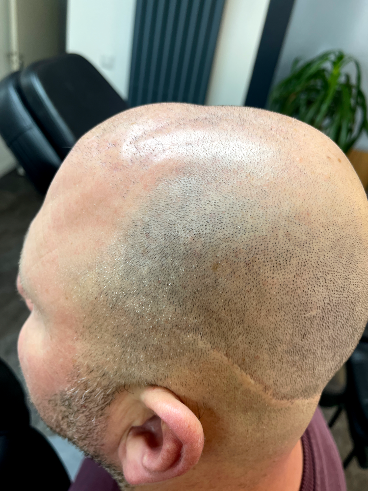dfineclinic_micro-haar-pigmentatie_4